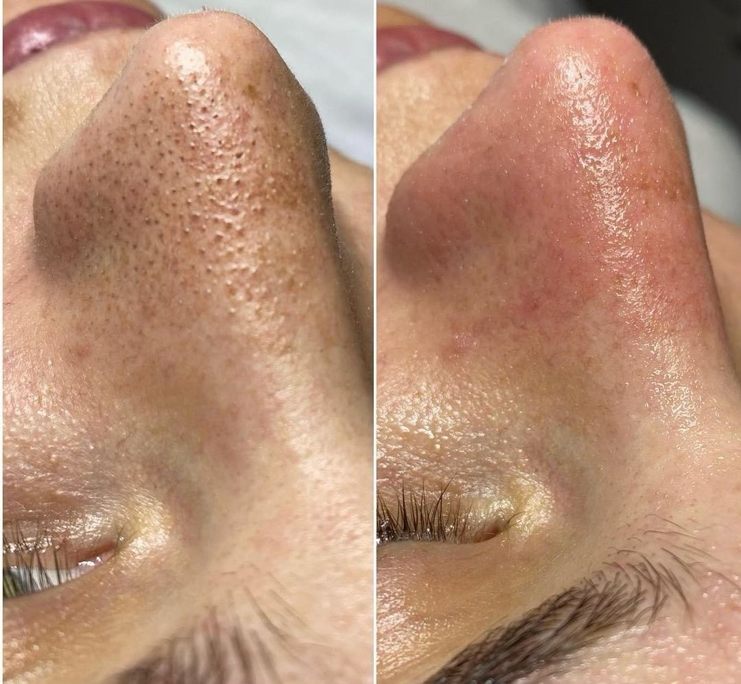 Help, hoe verwijder ik zwarte puntjes?