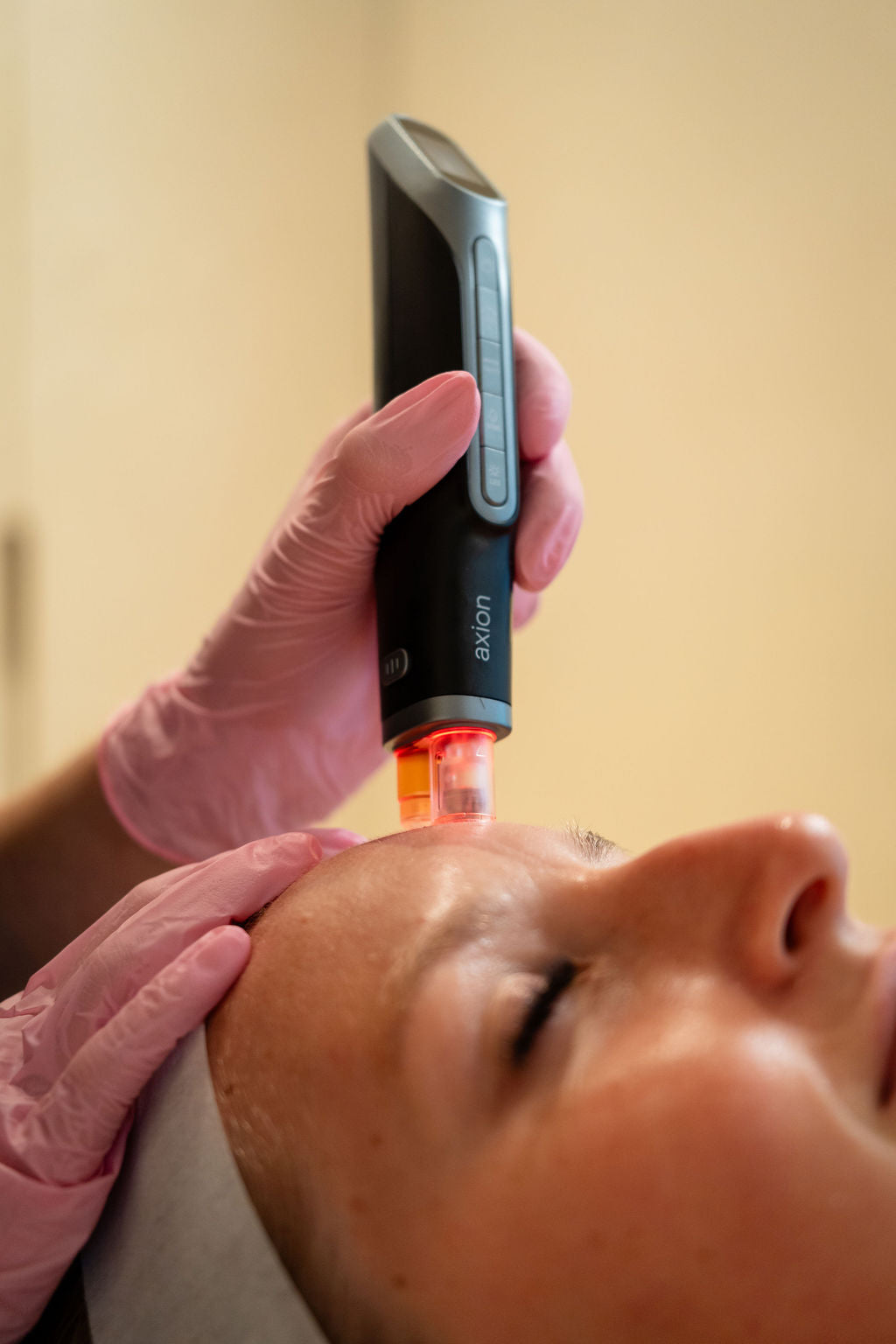 Microneedling met de Axion pen op het voorhoofd